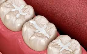 Sigillature Dentali: La Protezione per Sorrisi Brillanti e Sani