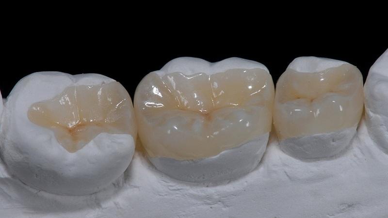 Intarsio Dentale: L’alternativa moderna alle corone dentali