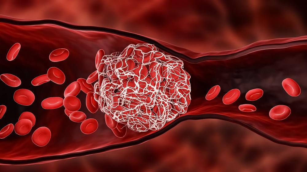 Trombocitopenia trombotica indotta da vaccino (VITT): primo rapporto dall'India