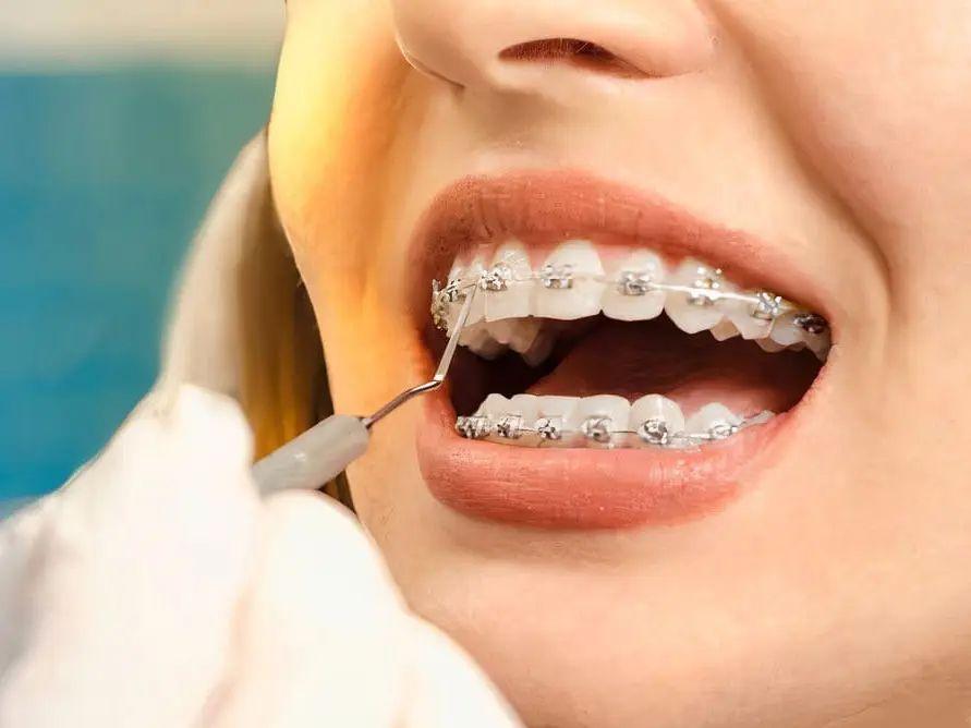 Apparecchio dentale tradizionale clinica dentale dott. Gino Ambrosio San Giuseppe Vesuviano