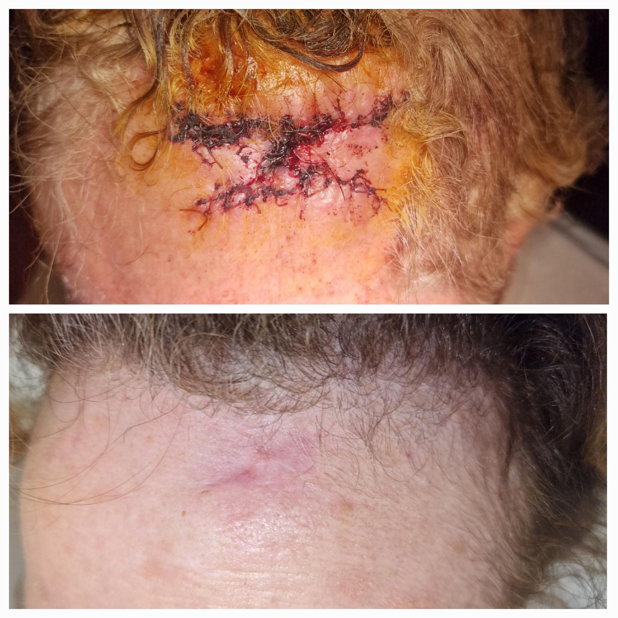 Cicatrici e acido ialuronico dopo tumore della fronte