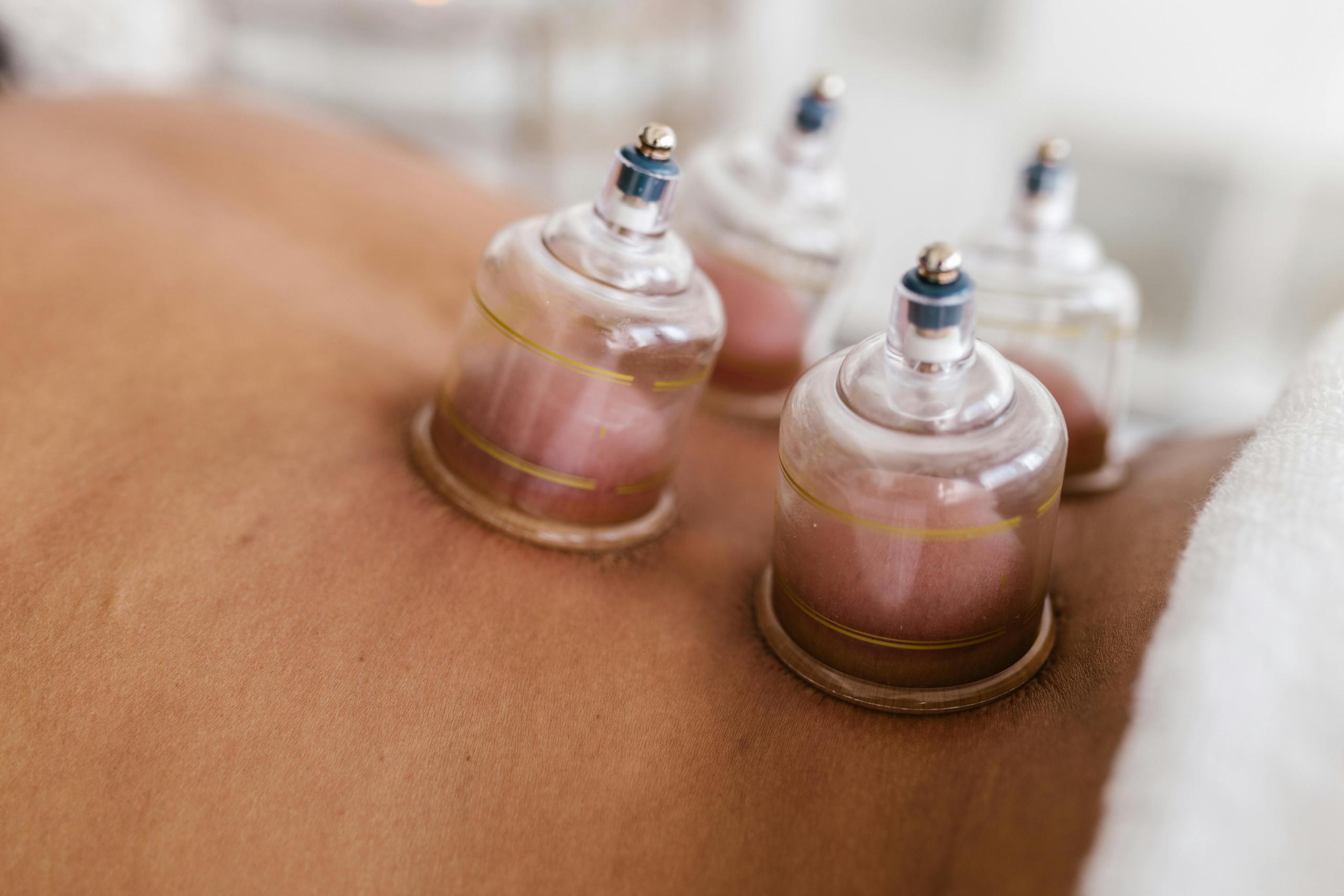 Exploring the Benefits of Cupping Therapy
