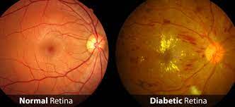 Retinopatia diabetica trattata con HECT (High Energy Cell Treatment)