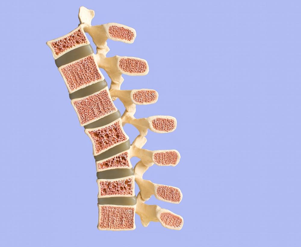 Osteoporosi: Come la Fisioterapia e l'Esercizio Fisico Possono Fare la Differenza