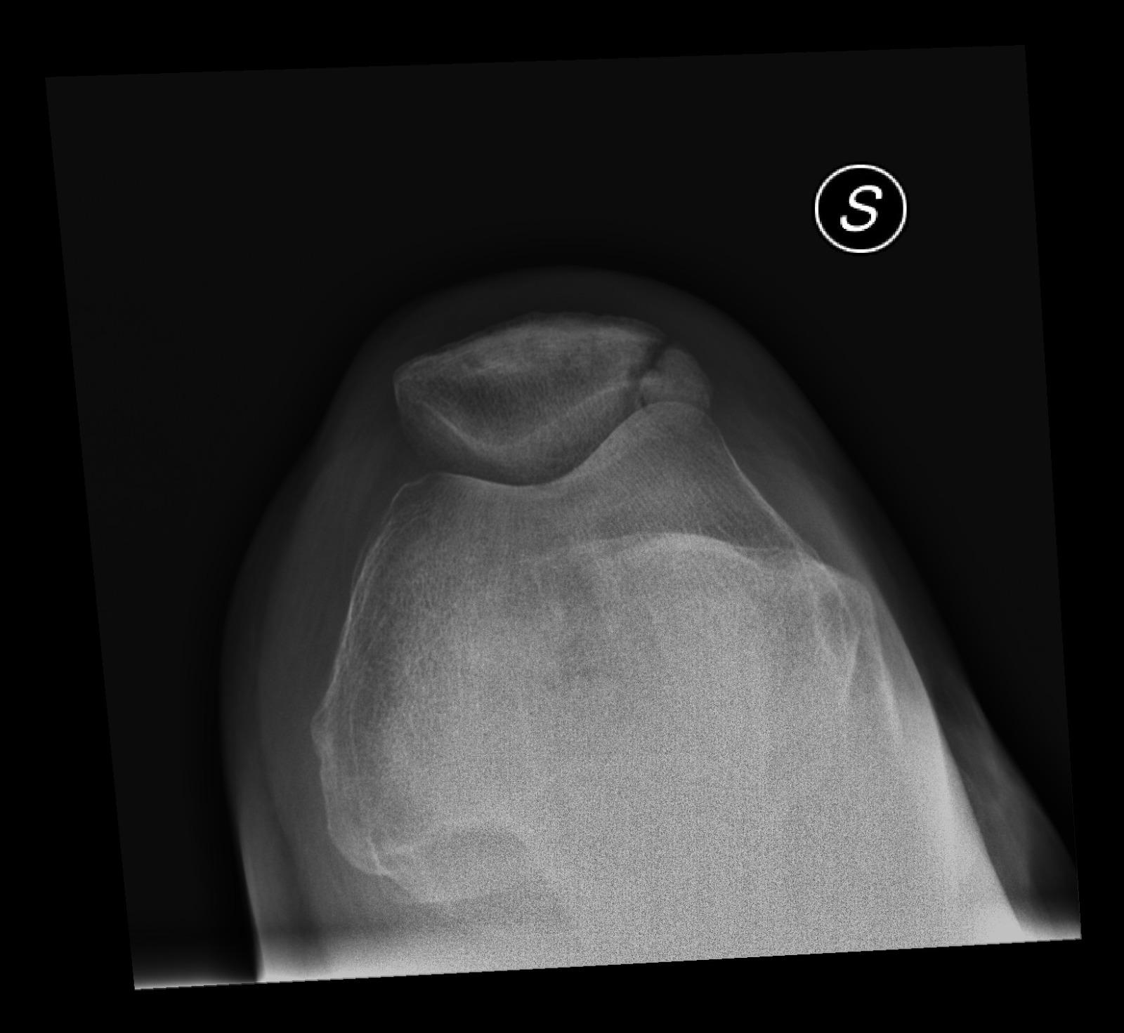 Frattura osteoarticolare scomposta della rotula sul versante laterale curata con omniTron-pro