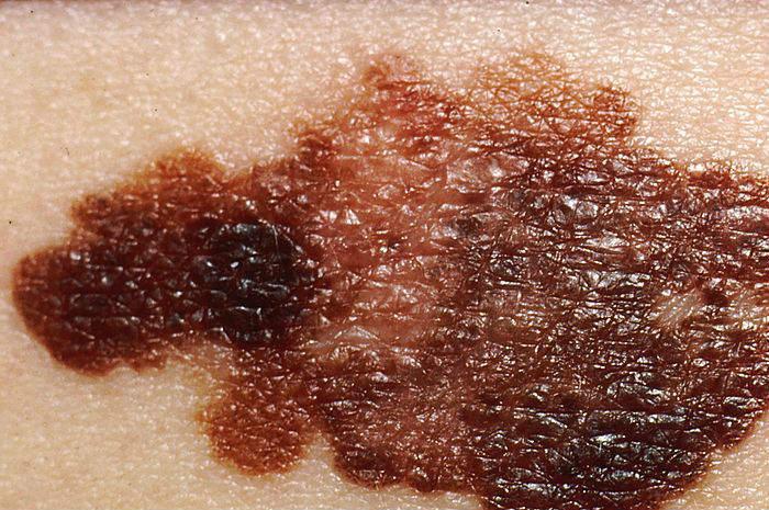 Una nuova terapia a campi elettrici pulsati per il melanoma interrompe l'afflusso di sangue del tumore e provoca una remissione completa senza recidiva .