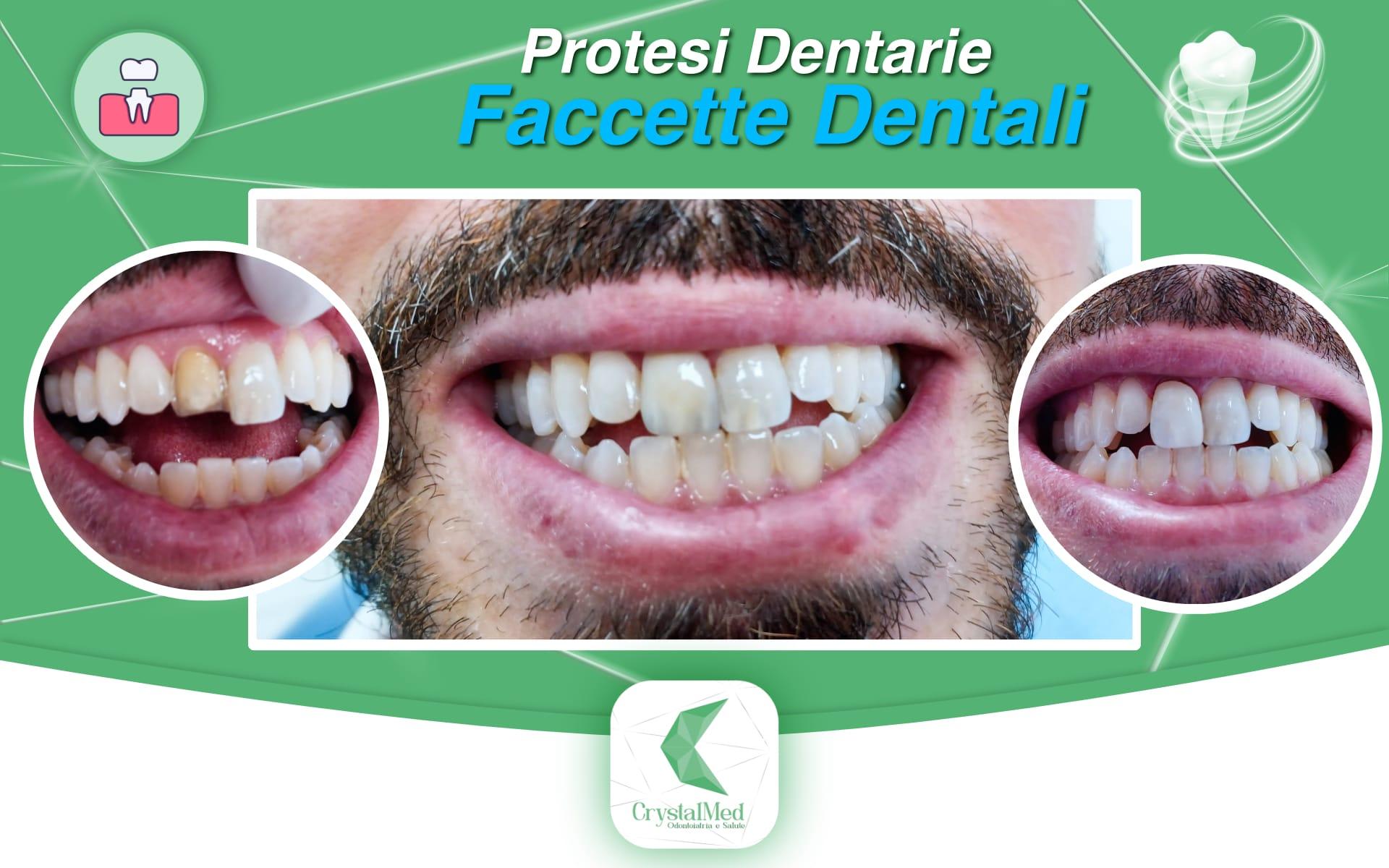 Protesi Dentarie - Faccette Dentali