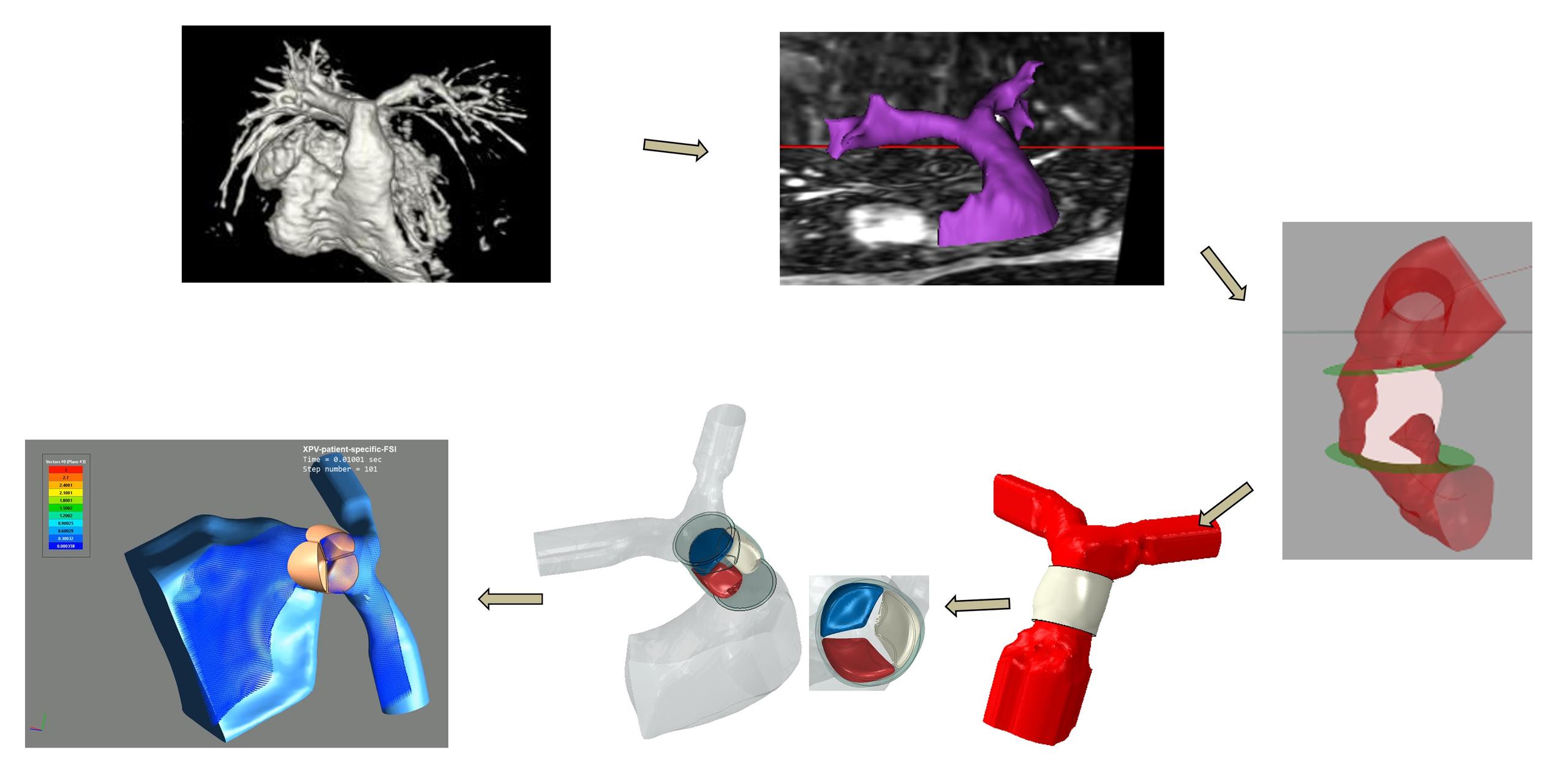 Milestone #15 successfully achieved through patient-specific modeling of tissue-engineered heart valves in young patients