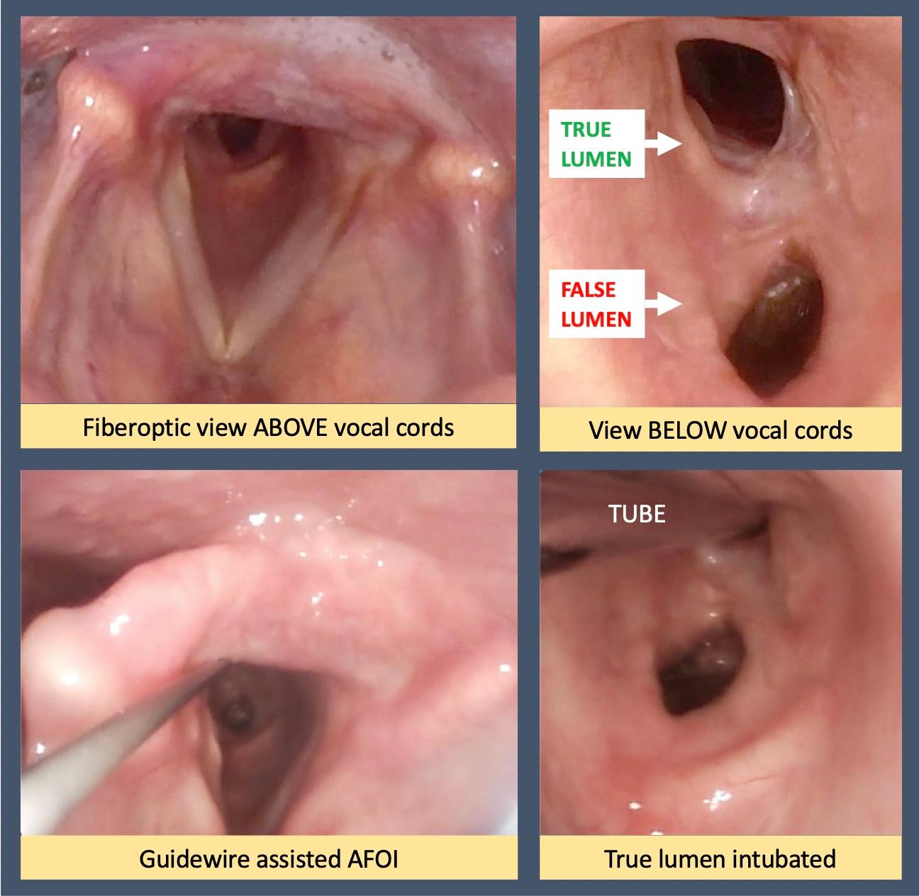 Subglottic stenosis and false lumenjpg