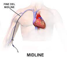 Posizionamento Midline