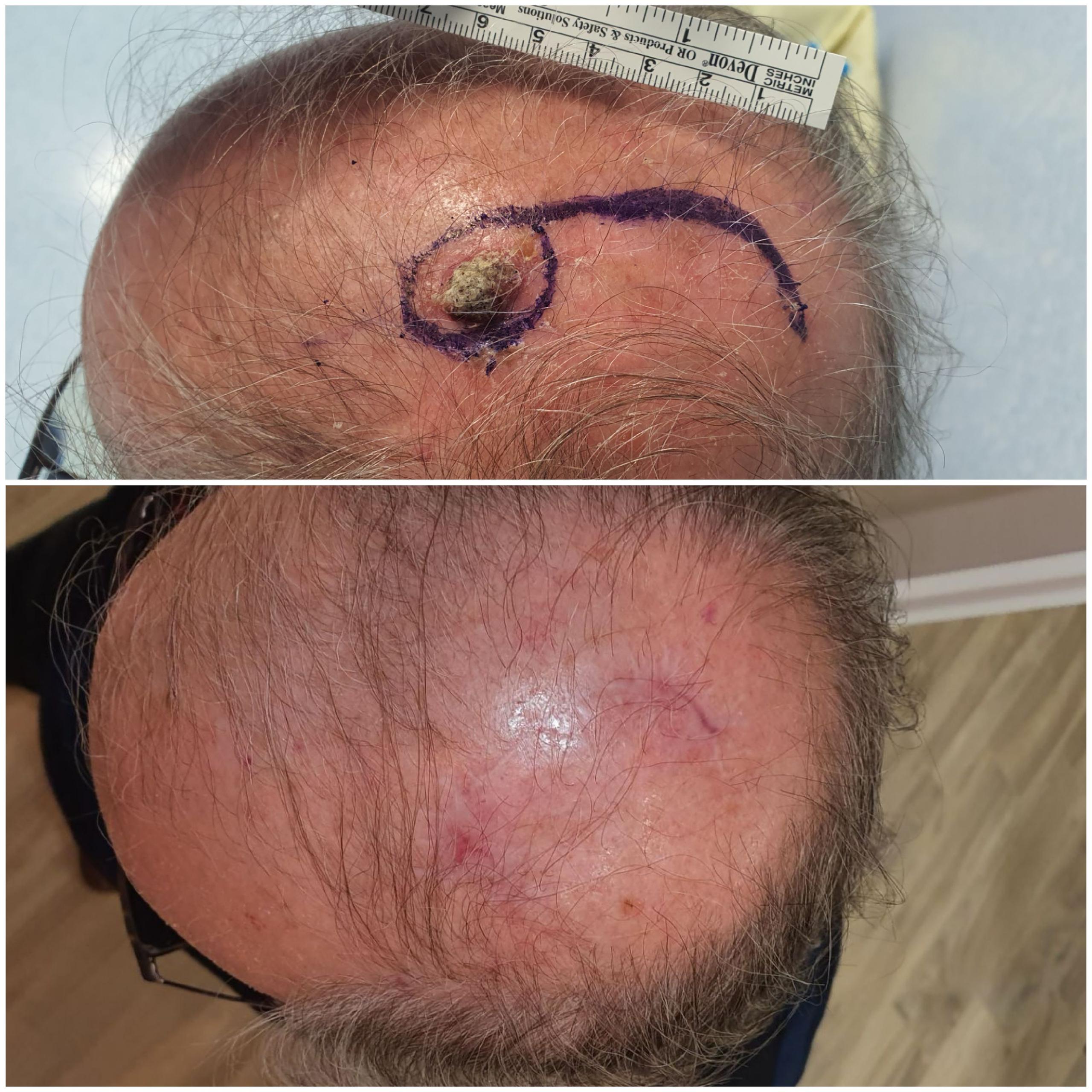 Cicatrici e acido ialuronico dopo tumore del cuoio capelluto