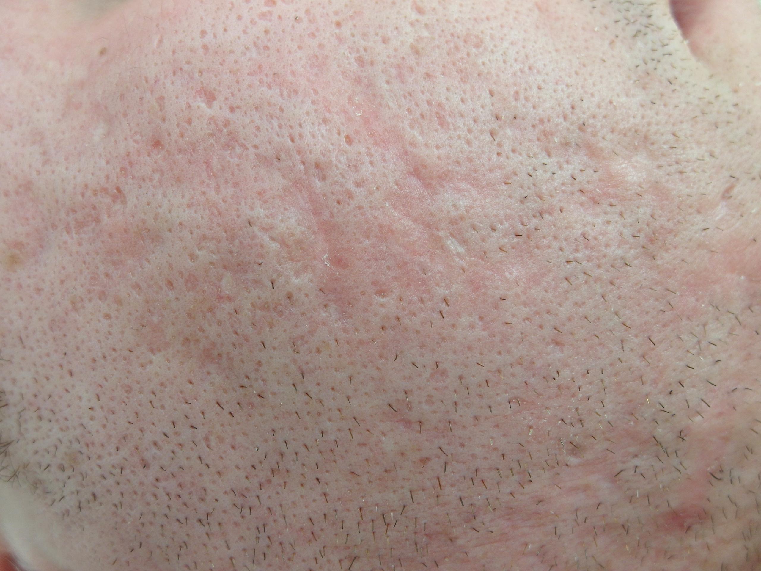 L'agopuntura nel trattamento dell'acne